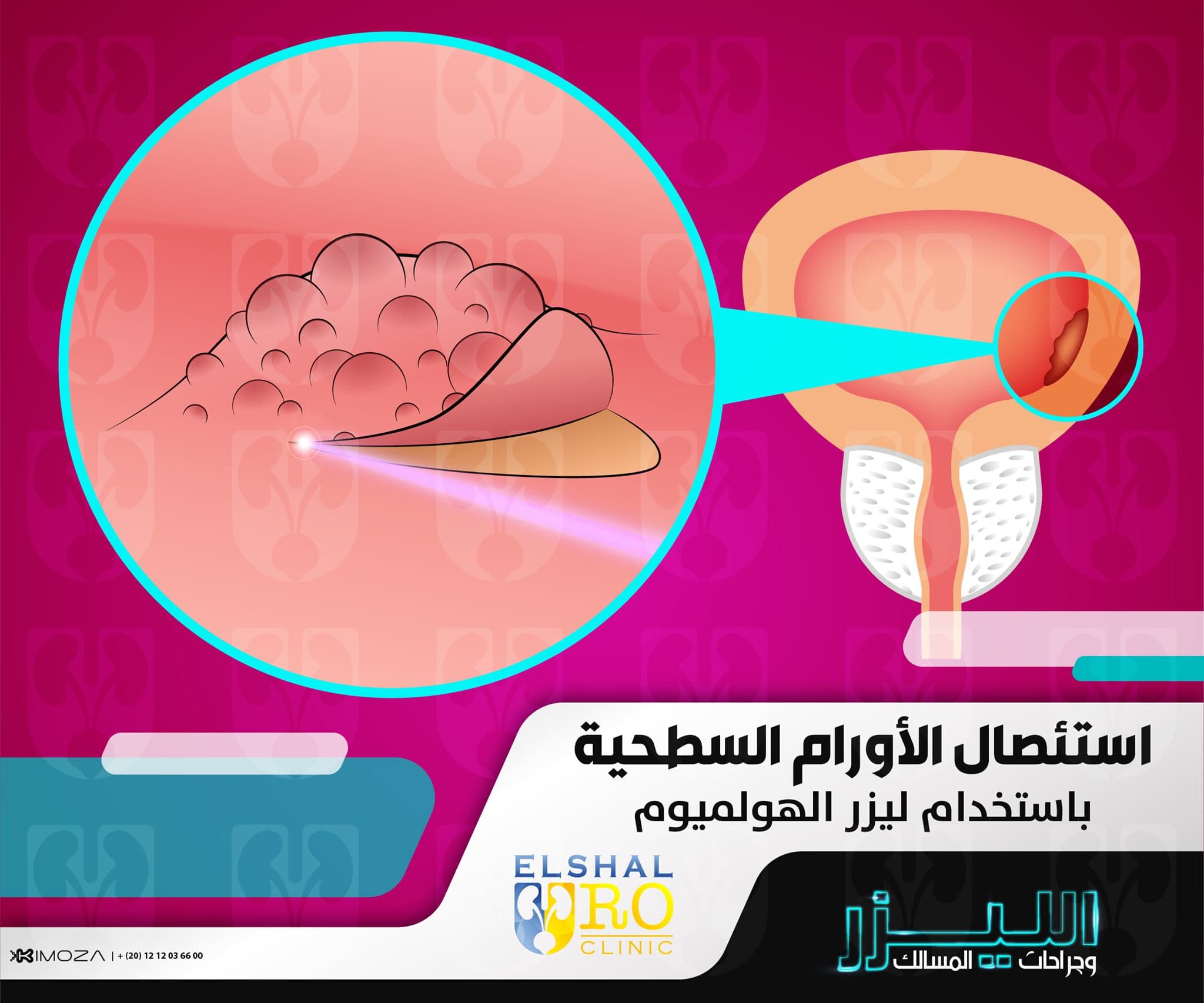 The Endoscopy Revolution in Urology