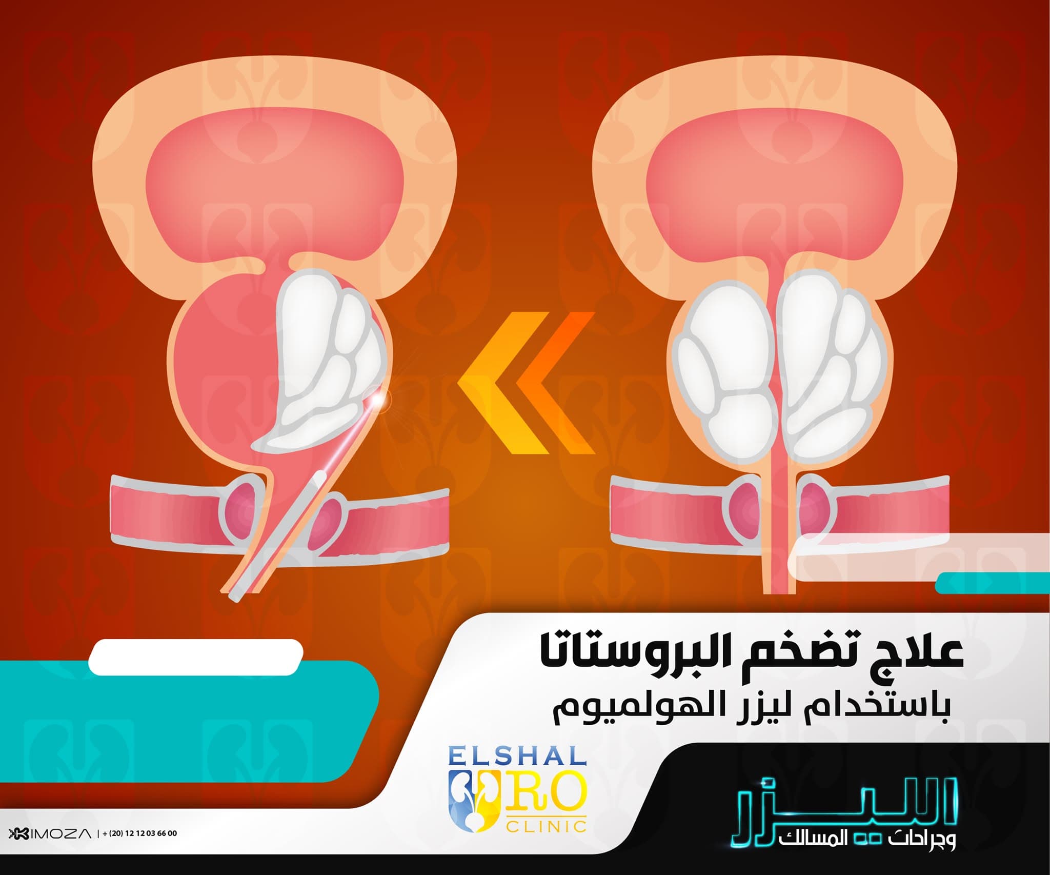 BPH Symptoms and Modern Treatment Options