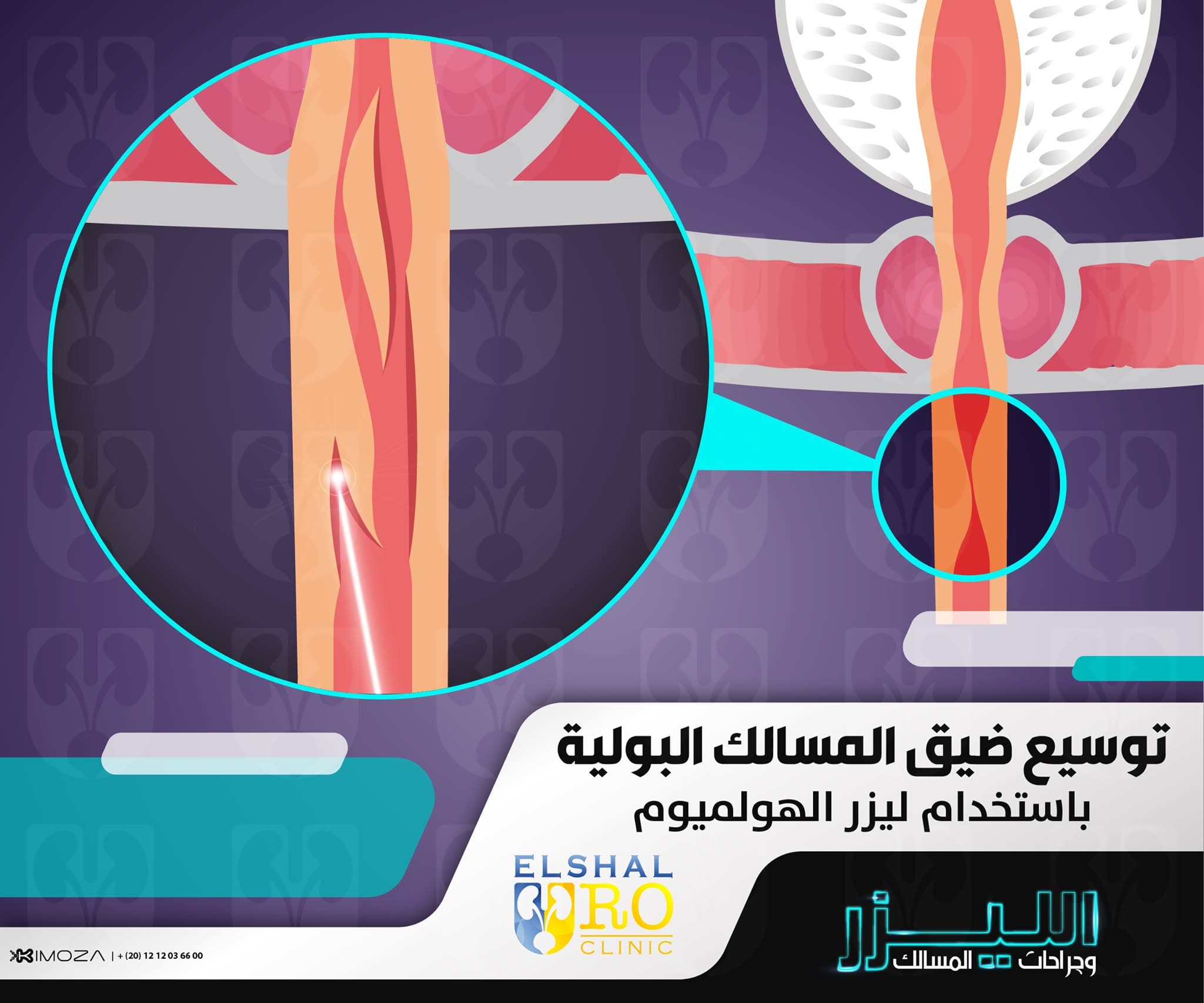 Tips for Preventing Urinary Tract Infections