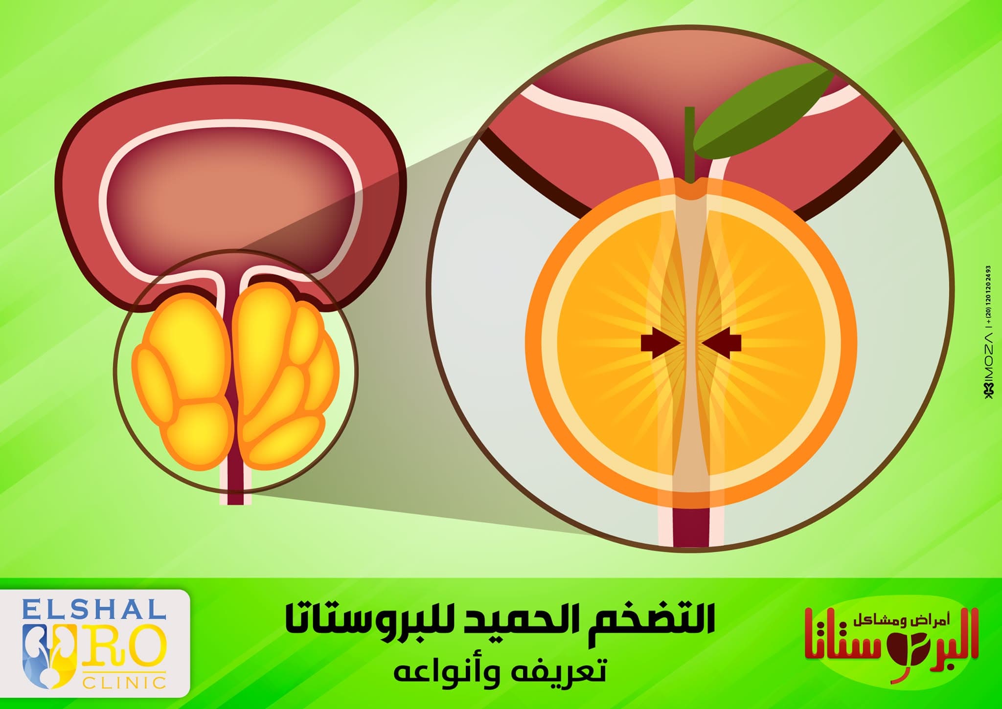 التضخم الحميد للبروستاتا